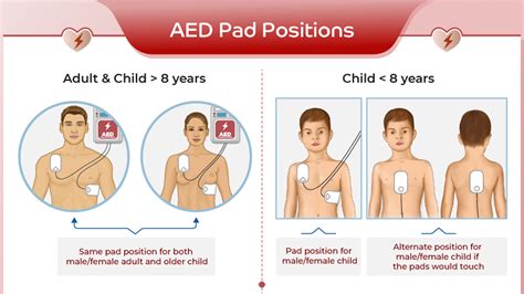 funest Poate Obraznic aed pad placement secol Bebelus alege