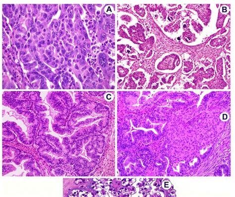 PATHfinder: Ovarian carcinomas as five distinct diseases.