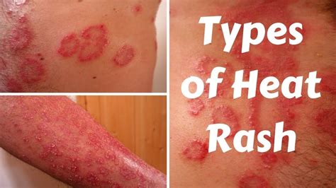 Types of Heat Rash | Heat rash, Types of skin rashes, Rashes