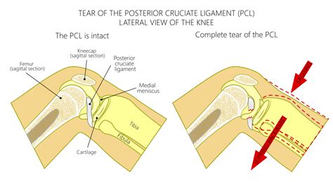 PCL Injury - Austin Chen MD