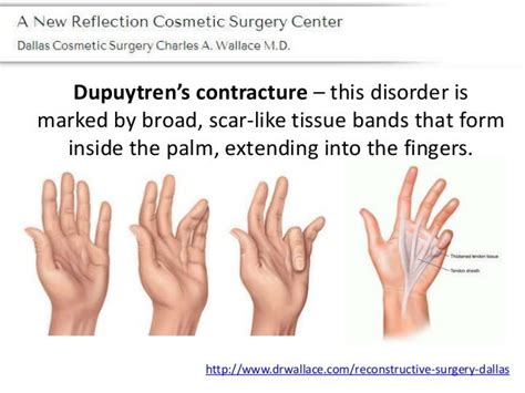 Types of hand deformations that can be cured with surgery