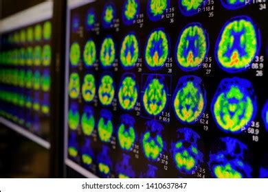 Pet Ct Scan Human Brain Axial Stock Photo 1410637847 | Shutterstock