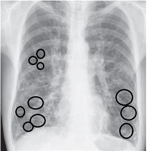 Chest Archives: C X Ray Bronchiectasis