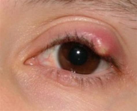 Stye Eye - Causes, Symptoms, Pictures, Treatment, Prevention | Diseases ...