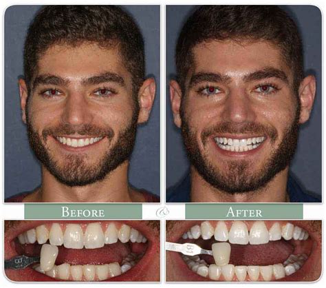 Smoking Teeth Before And After