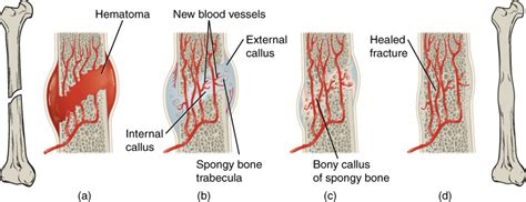 Fractures: Bone Repair | Anatomy and Physiology I