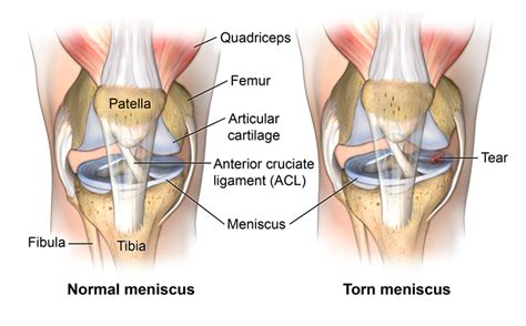 Torn Meniscus | Johns Hopkins Medicine