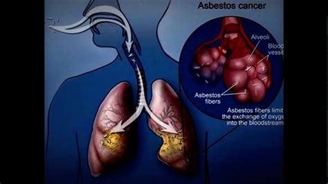 Asbestos Lung Cancer || Hospital NJ - YouTube