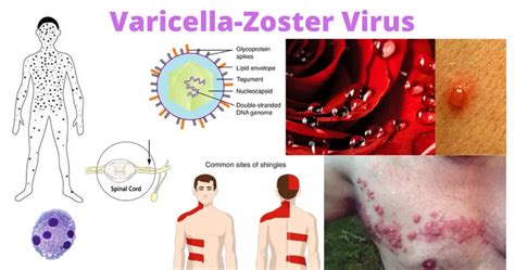 Varicella-Zoster Virus (VZV): Chicken Pox and Shingles – Microbe Online