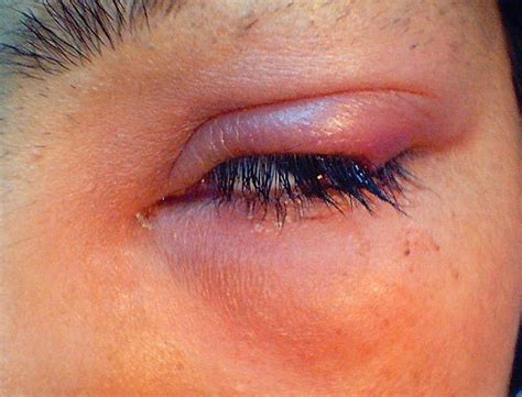 Eye Stye - Pictures, Treatment, Symptoms, Causes, Contagious