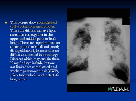 Asbestosis Chest X Ray Findings