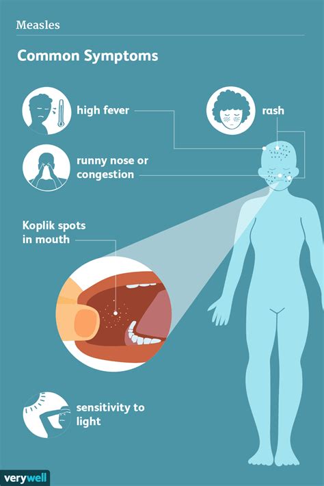 Measles: Signs, Symptoms, and Complications