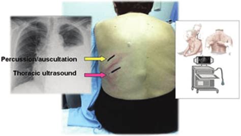 Figure. Choice of pleural biopsy entry point. Ultrasound enables biopsy ...