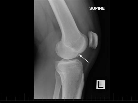 Can We Diagnose ACL Injuries Based on X-ray Findings Alone? | Axis ...