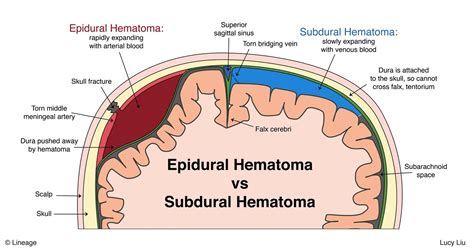 Epidural Hematoma - Neurology - Medbullets Step 2/3