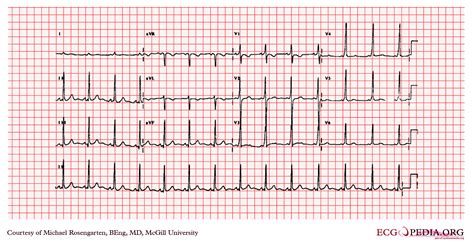 Wolff-Parkinson-White syndrome EKG examples - wikidoc