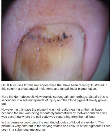 Consultations in Dermatology: Subungual hematoma