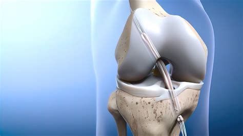 When Does an ACL Tear Require Surgery?: Sumit Dewanjee, MD: Orthopedic ...