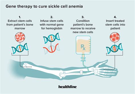 Sickle Cell Anemia and Gene Therapy: How It Works