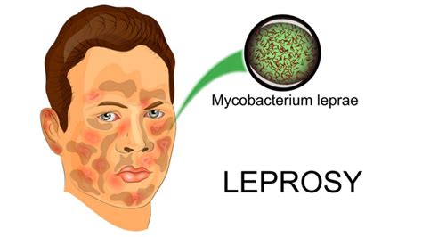 Leprosy - Symptoms, Treatment and More - Solution Parmacy