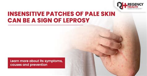 Leprosy (Hansen's Disease): Causes, Symptoms & Treatment