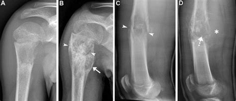 Osteosarcoma Radiology