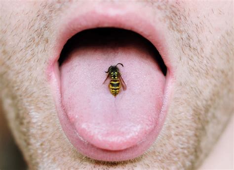 şu andan itibaren Göreceli boyut Bağış yellow jacket sting swelling ...