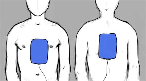 Cardiopulmonary Resuscitation (CPR)