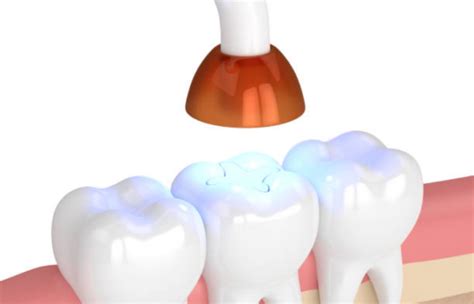 What Are The Unique Advantages Of Using White Fillings