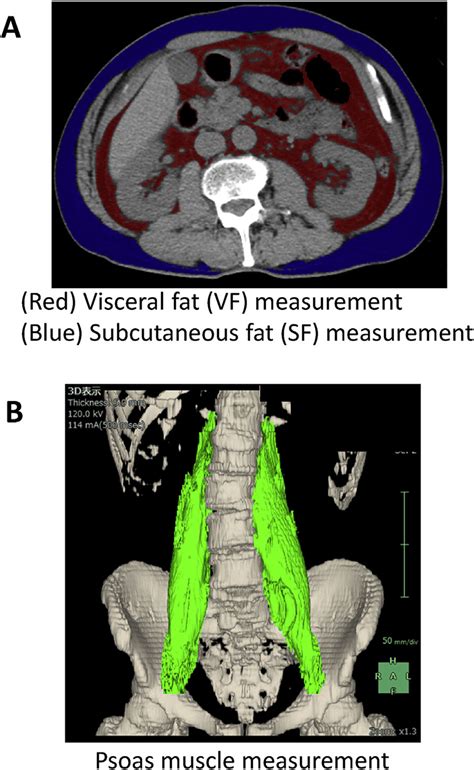 Measurement of (A) visceral and subcutaneous fat and (B) psoas muscle ...