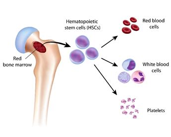 Stem cell transplant - Myeloma Patients Europe