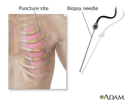 Pleural needle biopsy Information | Mount Sinai - New York