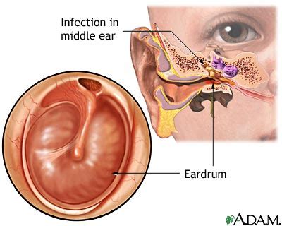 Ear infection - chronic: MedlinePlus Medical Encyclopedia