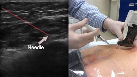 Dr. David Rosenblum: The Ultrasound Guided Superior Cluneal Nerve Block ...