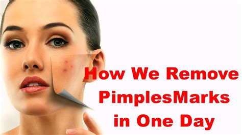 How to Remove Pimples Marks in One Day Get Rid Of Pimple Scars With ...