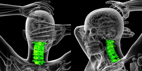 Signs and Symptoms of Degenerative Arthritis Neck - Okikiko