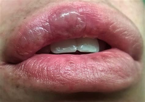 Help! huge blisters on lip!