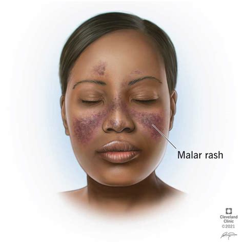 Lupus Rash: Types, Causes, Treatment & Prevention