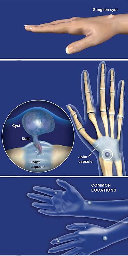 Ganglion Cysts of the Hand | Central Coast Orthopedic Medical Group