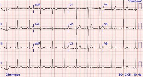 Repeat 12 lead EKG showing normal sinus rhythm. | Download Scientific ...