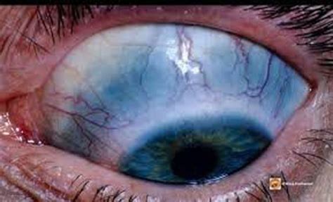 Causes of blue sclera - MEDizzy