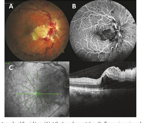 Figure 1 from Cilioretinal Artery Occlusion Combined with Central ...