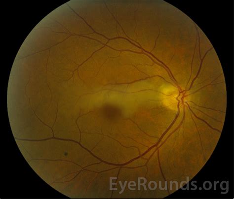 Atlas Entry - Cilioretinal Artery Occlusion