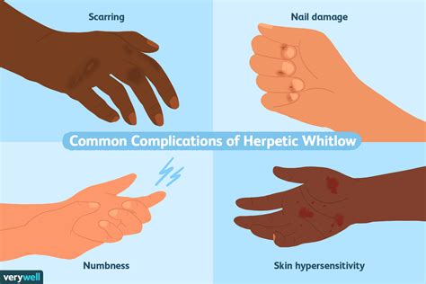 Herpetic Whitlow Symptoms, Causes and Treatment