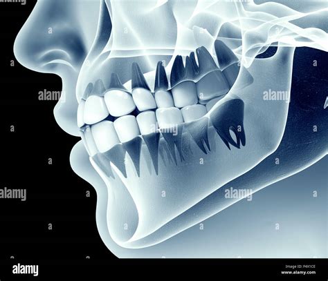 x-ray image of a jaw with teeth Stock Photo - Alamy