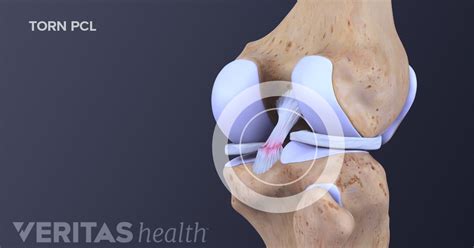 Posterior Cruciate Ligament Exercises