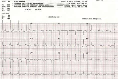 WPW After Cardioversion From Wide Complex Tachycardia | ECG Guru ...