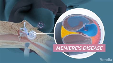 What is Meniere’s Disease? - ENTJC