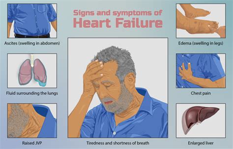 Congestive Heart Failure - Physiopedia