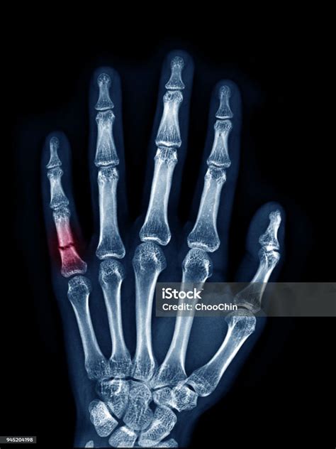 Xray Image Of Left Hand Show Fracture At Little Finger Upper View Area ...